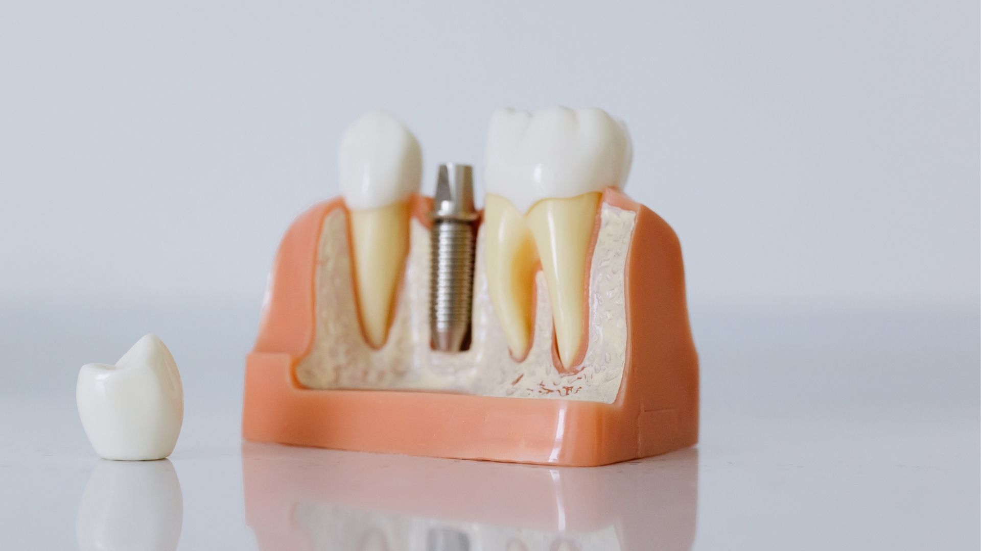 İmplant Diş Tedavisi Hakkında Bilmeniz Gereken Her Şey